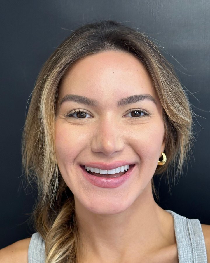 Sorriso depois do tratamento — Caso 1