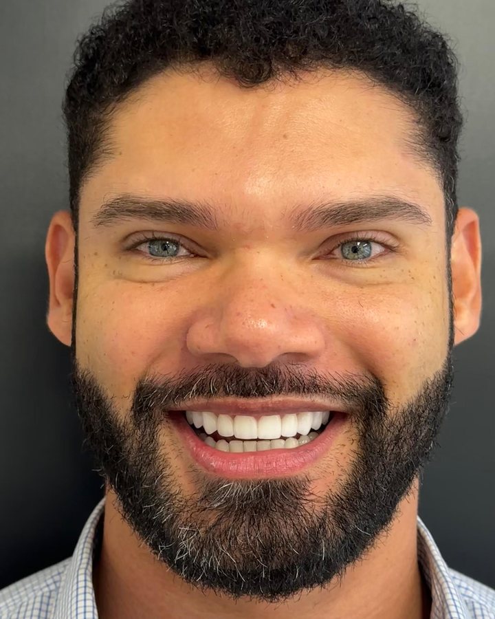 Sorriso depois do tratamento — Caso 3
